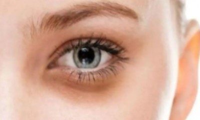 Causes of eye problems-Eye area - dark circles